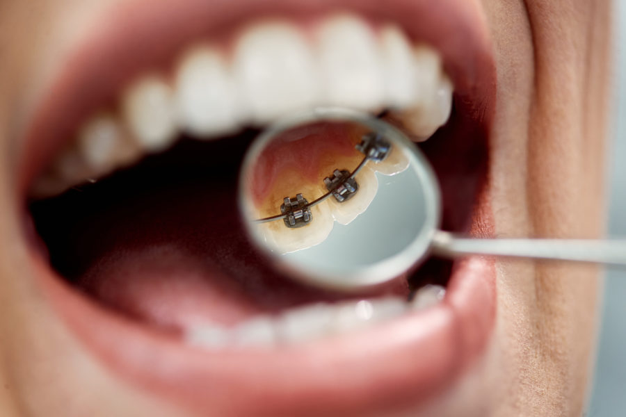 about lingual braces